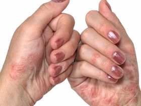 Tình trạng viêm da đầu ngón tay cảnh báo bệnh gì?